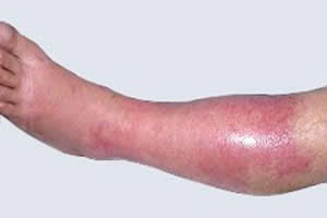 ERISIPELA