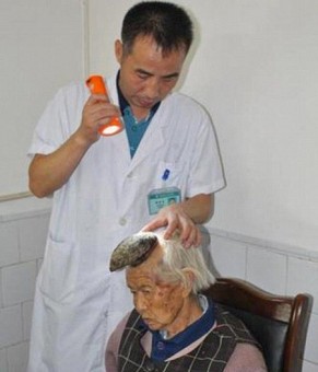 Chifre cutâneo